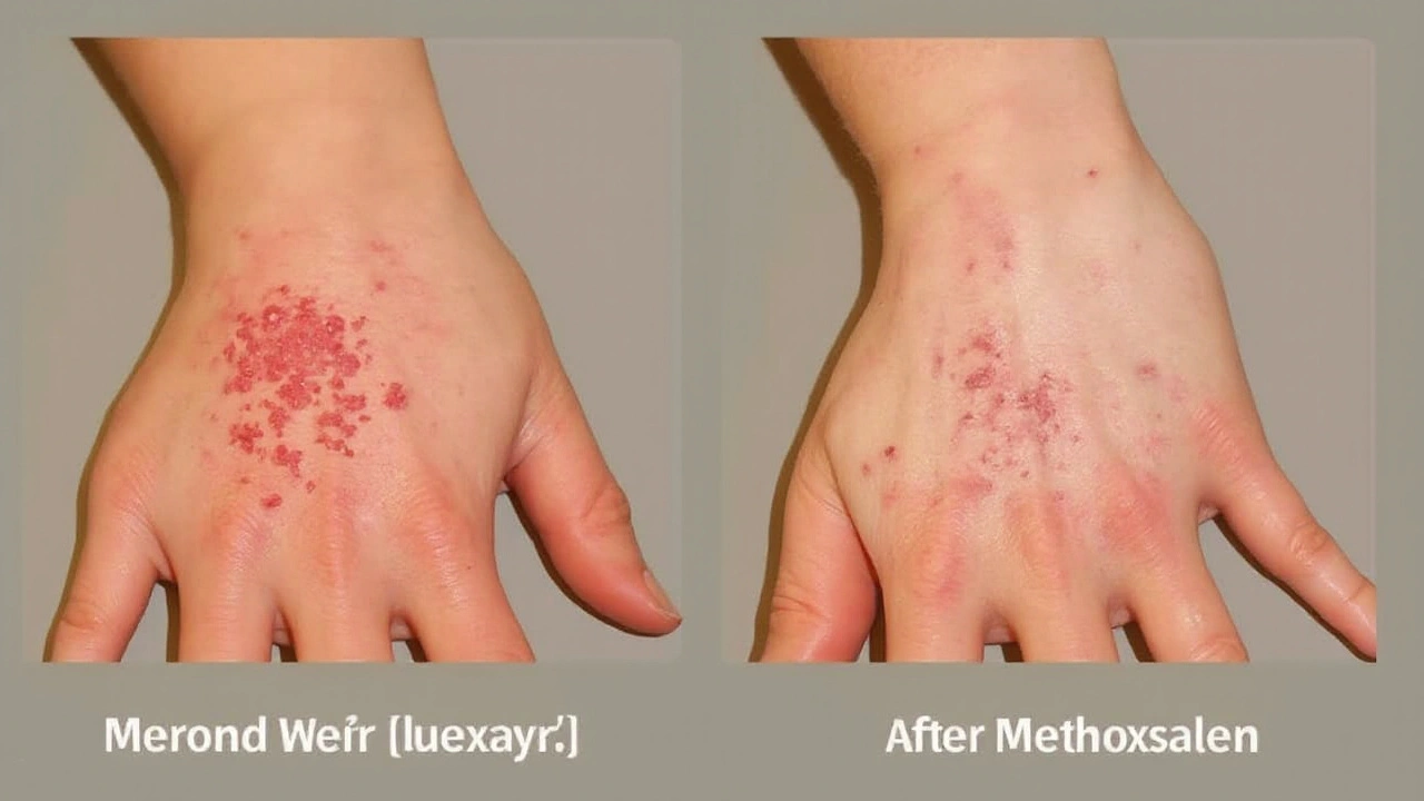 Benefits of Methoxsalen Therapy